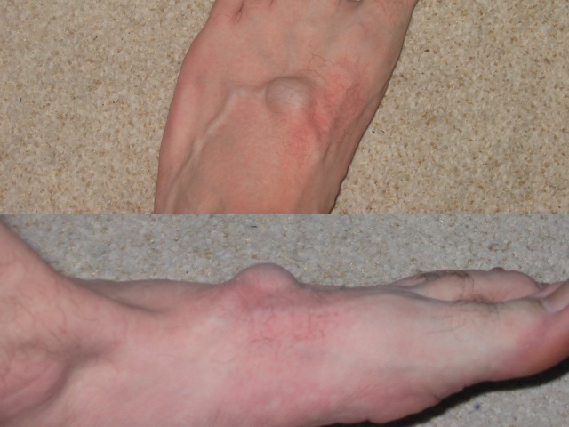 Lumps and Bumps on Top of the Feet | Seattle Podiatrist